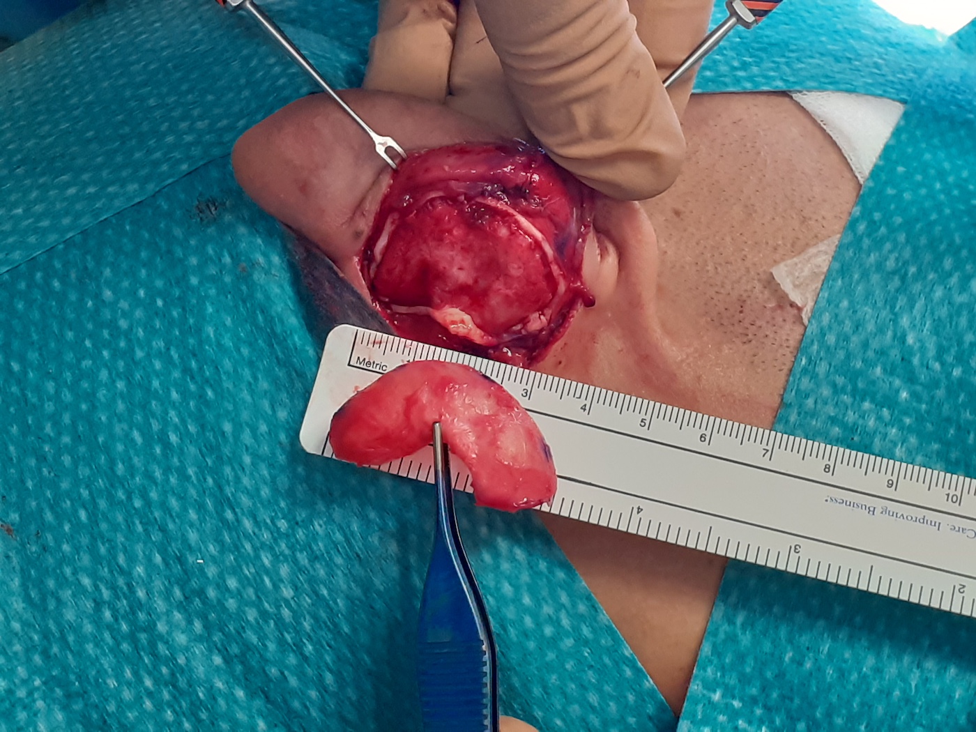 Ear cartilage graft rhinoplasty ERM EAFPS