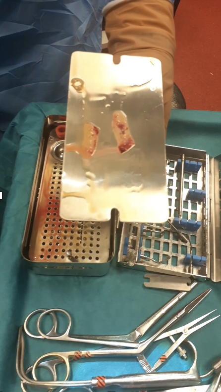 PRF membrane rhinoplasty regenerative technique ERM EAFPS