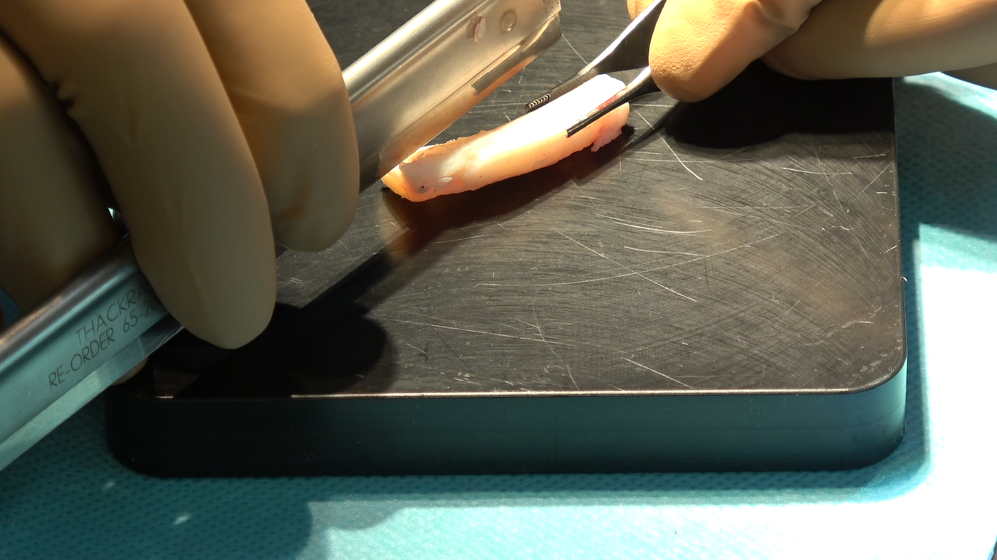 Rib cartilage graft preparation revision rhinoplasty ERM EAFPS