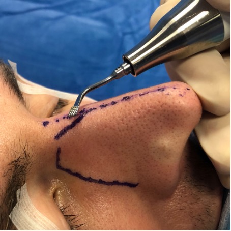 Ultrasonic piezo device rhinoplasty ERM EAFPS