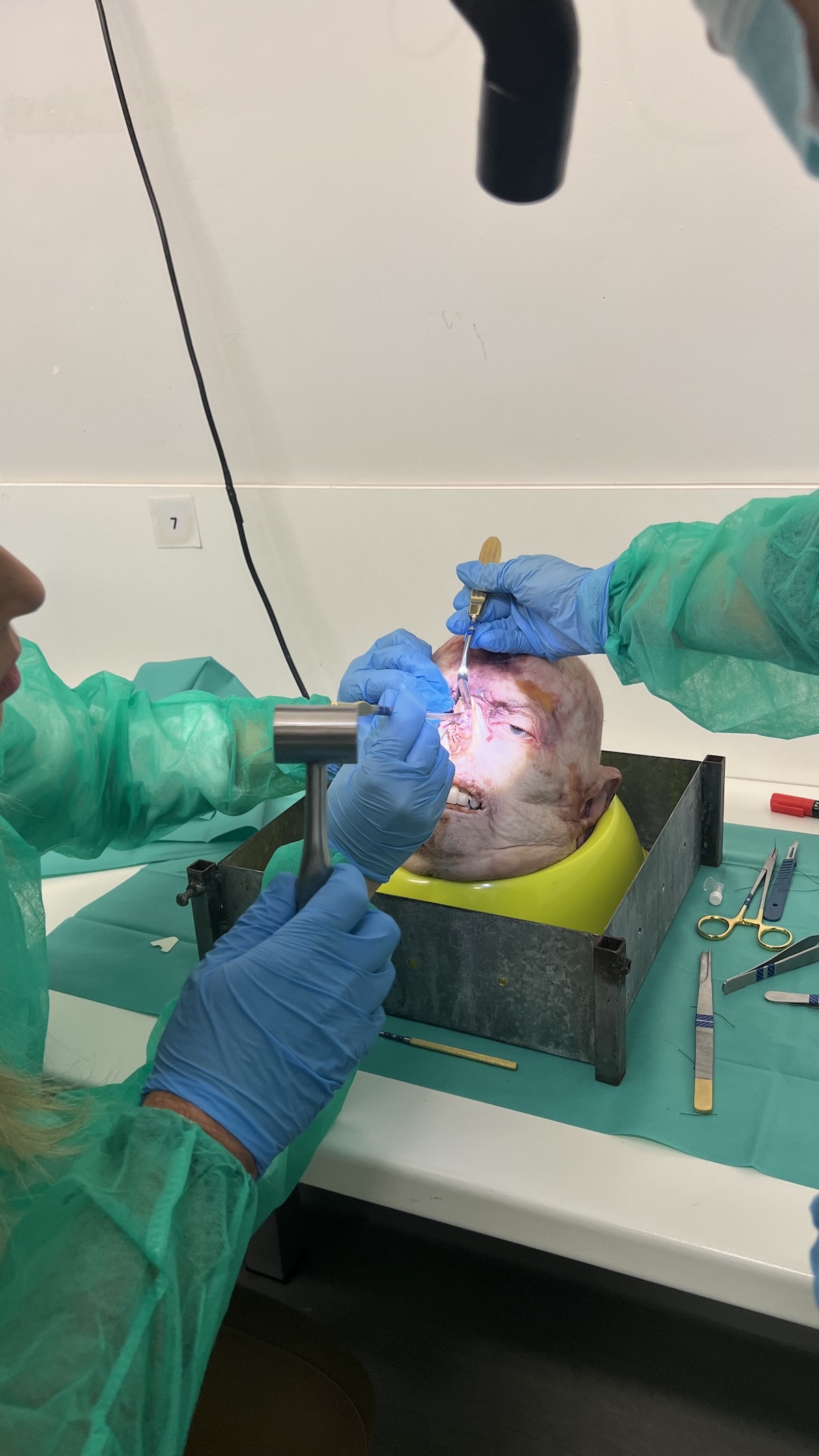 Small-group cadaver rhinoplasty dissection training session in Athens in 2024