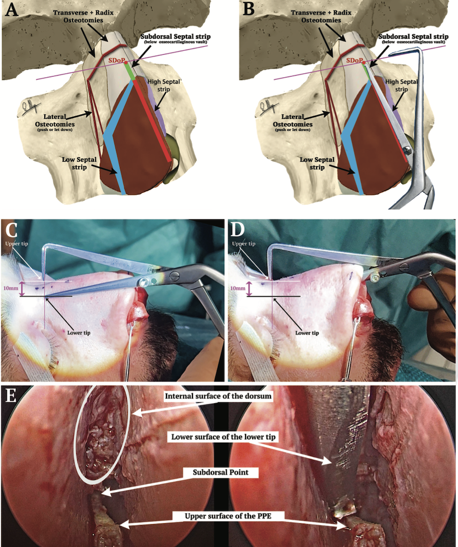 Nasal Locator used during rhinoplasty to identify subdorsal point and guide osteotomy lines with intraoperative views