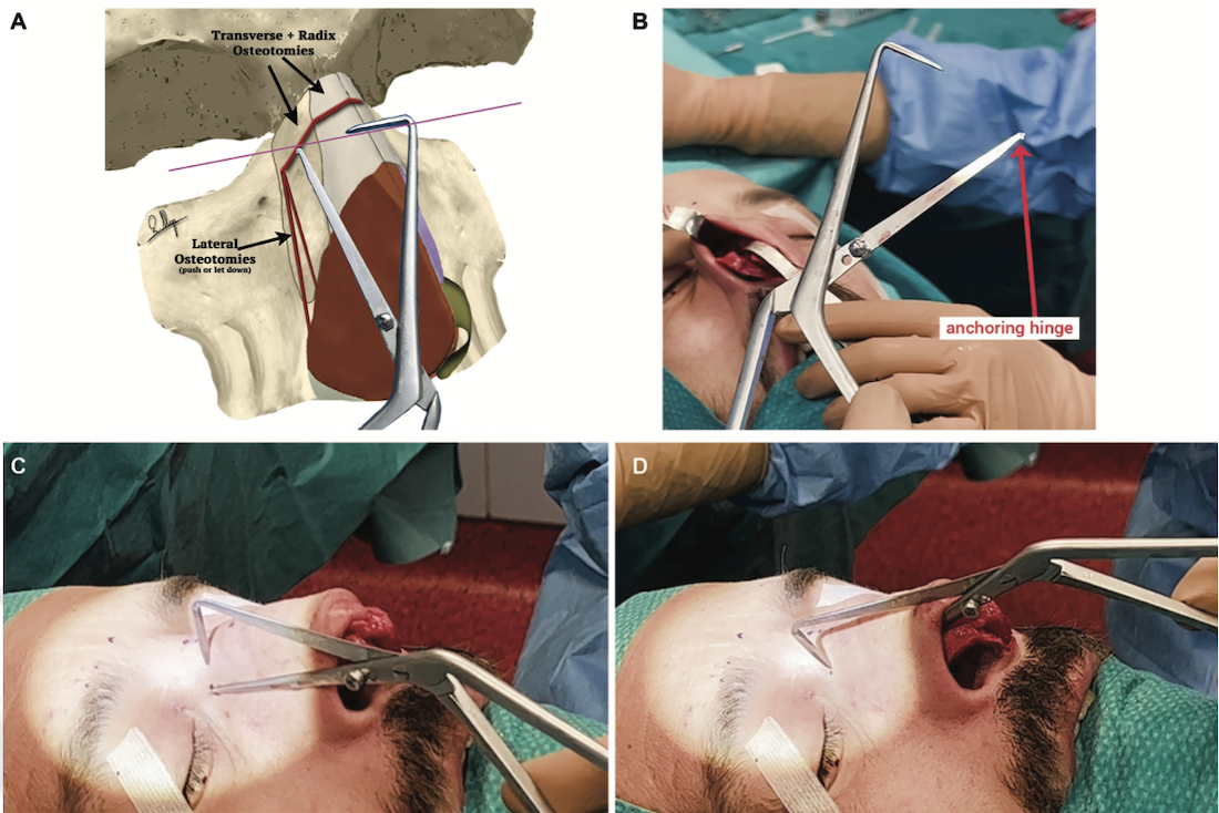 Nasal Locator instrument positioned on the nose during rhinoplasty to guide osteotomy planning