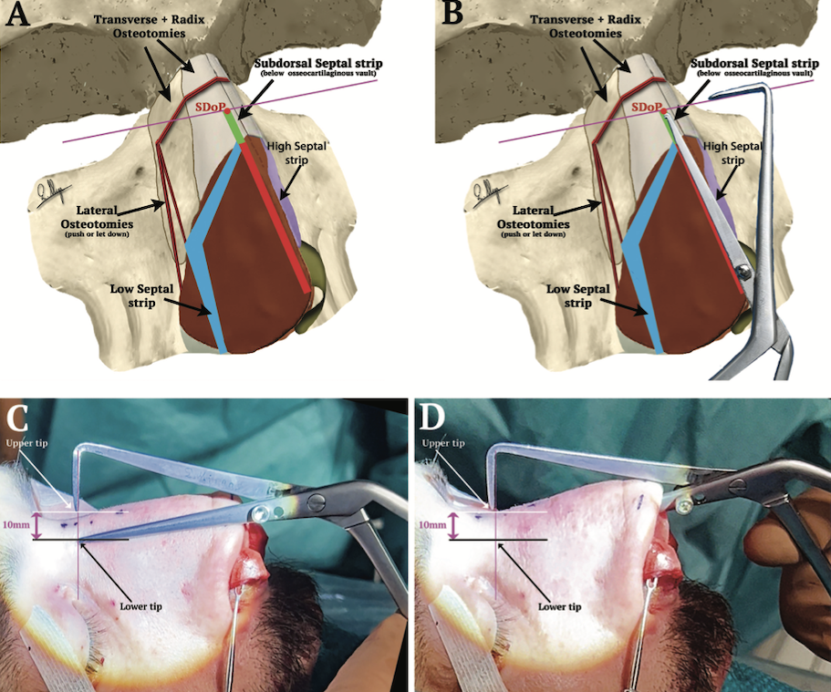 Academic activity and surgical innovation in rhinoplasty including education, publications and instrument development