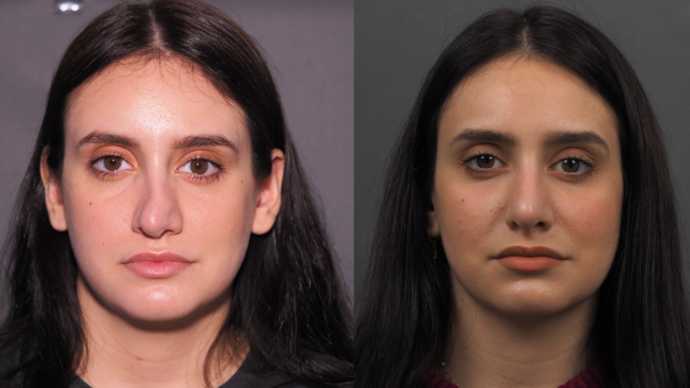 Before and after revision rhinoplasty showing correction of asymmetry and improved nasal balance
