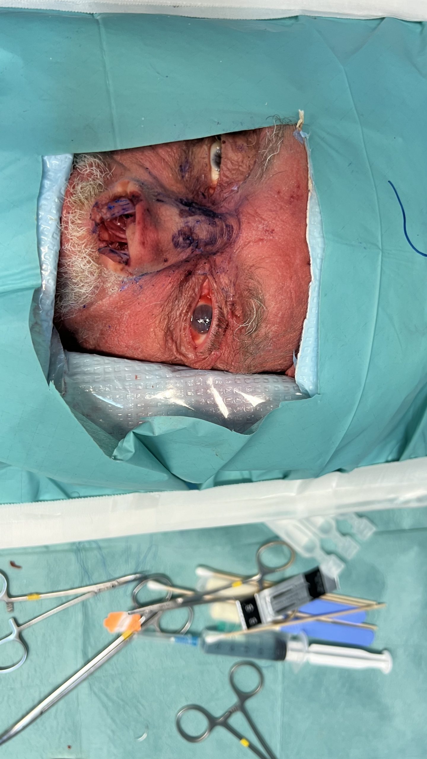 Prepared cadaver specimen for rhinoplasty dissection during RHINODAYS 2024 cadaver course in Thessaloniki