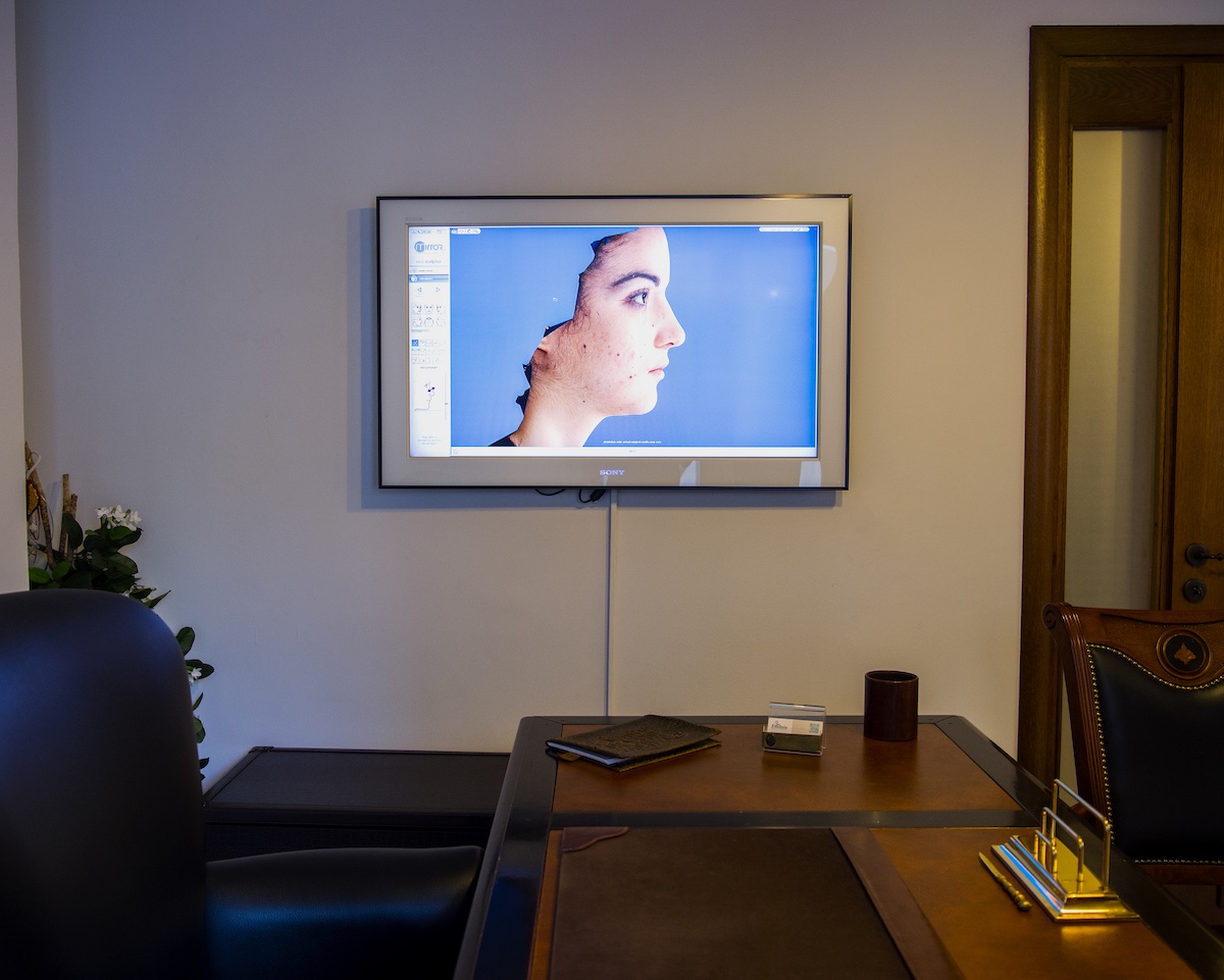 Digital rhinoplasty simulation showing facial analysis and profile comparison